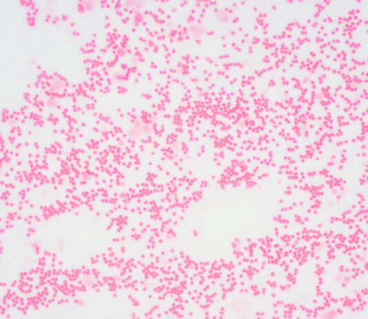 Myelofibrose: Neue Behandlungsmöglichkeiten für seltenen Blutkrebs in Sicht