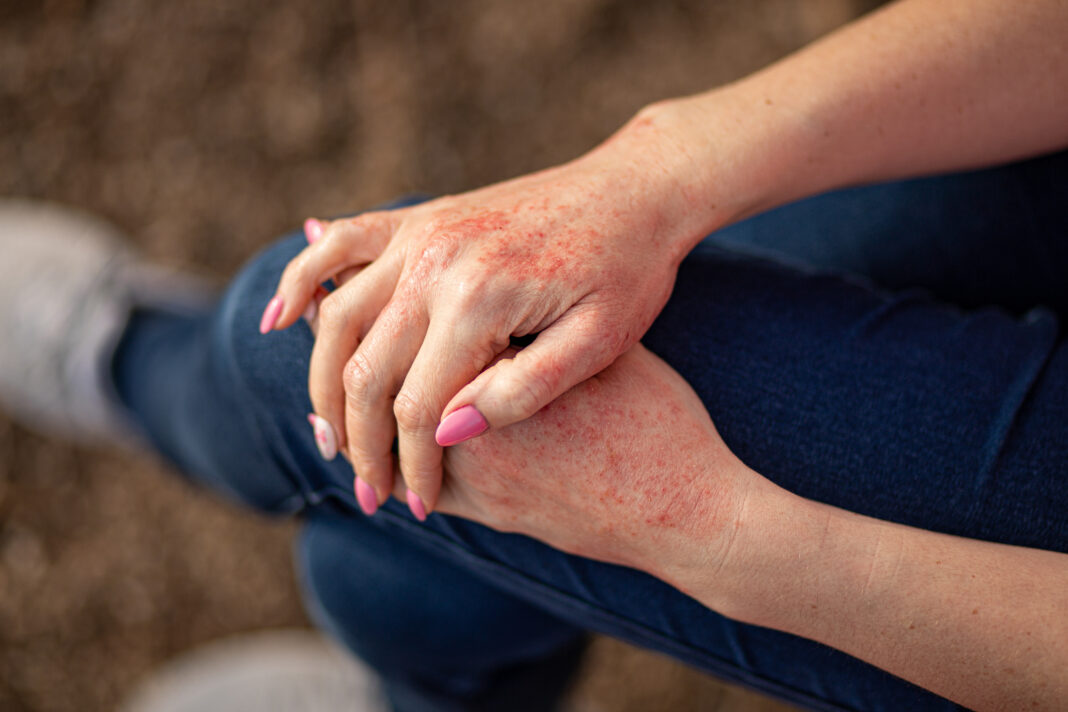 Close up dermatitis on skin. Copyright: InfiniteStudio - stock.adobe.com