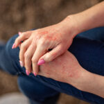 Close up dermatitis on skin. Copyright: InfiniteStudio - stock.adobe.com