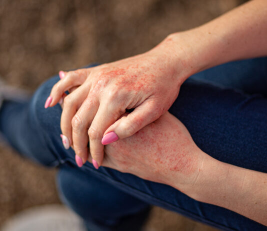 Forbion verkauft Numab Therapeutics-Tochtergesellschaft an Johnson & Johnson Close up dermatitis on skin. Copyright: InfiniteStudio - stock.adobe.com