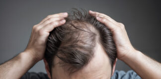 Symbolbild „Haarausfall“. (A man with hair fall health problem holding his hair to reveals bald head. Concept of aging fallen hair health breaking falling problem.) Copyright: ribah – stock.adobe.com