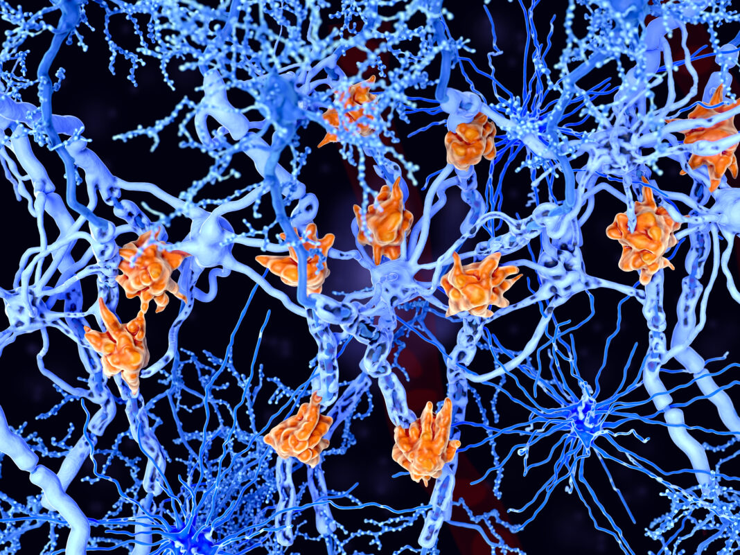 Multiple sclerosis (MS): microglia cells damage the myelin sheath of neuron axons. Copyright: Juan Gärtner - stock.adobe.com