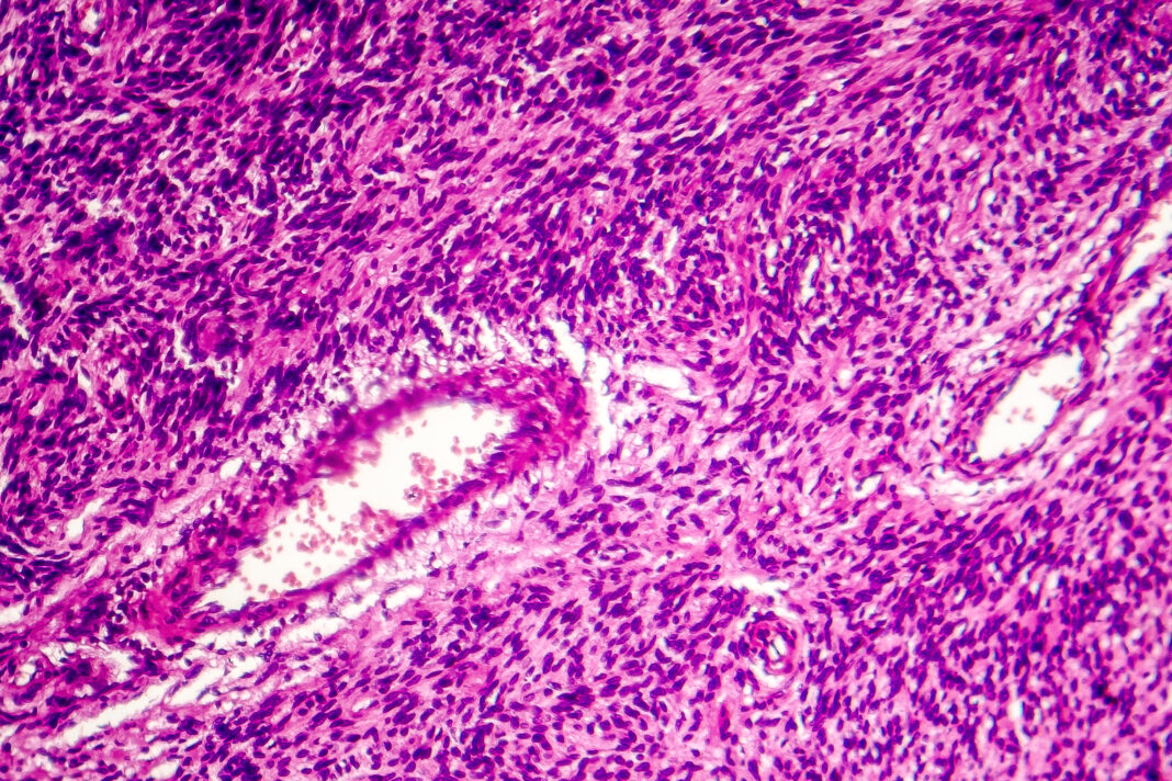 Symbolbild. Fibrosarcoma, malignant tumor of fibroblasts, one of soft tissue sarcomas, light micrograph, photo under microscope. Copyright: Dr_Microbe - stock.adobe.com