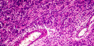 Symbolbild. Fibrosarcoma, malignant tumor of fibroblasts, one of soft tissue sarcomas, light micrograph, photo under microscope. Copyright: Dr_Microbe - stock.adobe.com