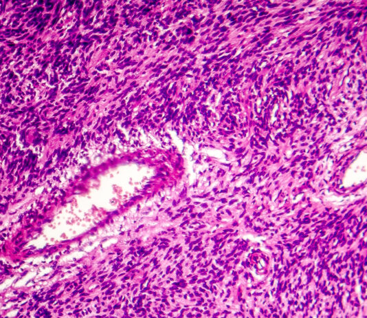 Symbolbild. Fibrosarcoma, malignant tumor of fibroblasts, one of soft tissue sarcomas, light micrograph, photo under microscope. Copyright: Dr_Microbe - stock.adobe.com