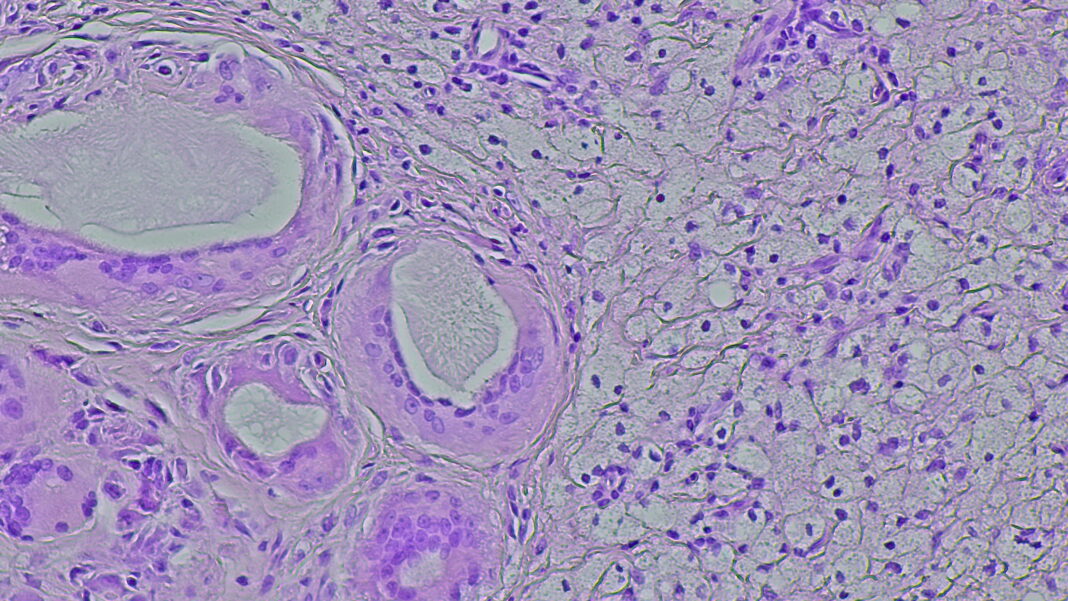 Symbolbild. Photomicrograph of a soft tissue tumor in the dextra manus area in the anatomical pathology laboratory. Copyright: DMH - stock.adobe.com