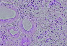 Symbolbild. Photomicrograph of a soft tissue tumor in the dextra manus area in the anatomical pathology laboratory. Copyright: DMH - stock.adobe.com