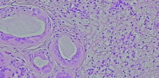 Symbolbild. Photomicrograph of a soft tissue tumor in the dextra manus area in the anatomical pathology laboratory. Copyright: DMH - stock.adobe.com