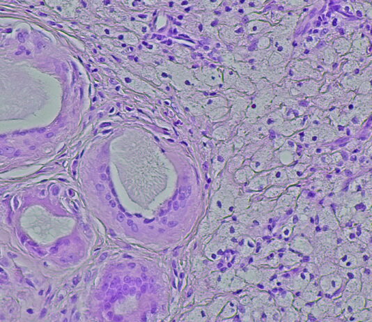 Symbolbild. Photomicrograph of a soft tissue tumor in the dextra manus area in the anatomical pathology laboratory. Copyright: DMH - stock.adobe.com