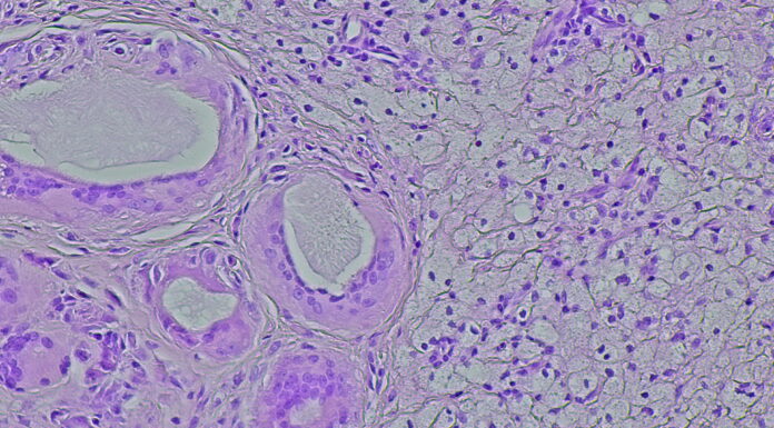 Symbolbild. Photomicrograph of a soft tissue tumor in the dextra manus area in the anatomical pathology laboratory. Copyright: DMH - stock.adobe.com