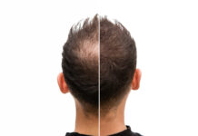 Symbolbild. Vorher Nachher - Halbglatze eines Mannes mit Haarausfall. Copyright: unigraphy - stock.adobe.com