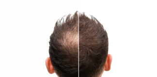 Symbolbild. Vorher Nachher - Halbglatze eines Mannes mit Haarausfall. Copyright: unigraphy - stock.adobe.com