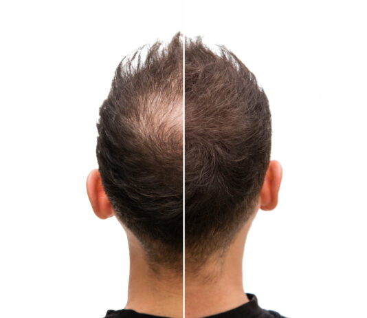 Symbolbild. Vorher Nachher - Halbglatze eines Mannes mit Haarausfall. Copyright: unigraphy - stock.adobe.com