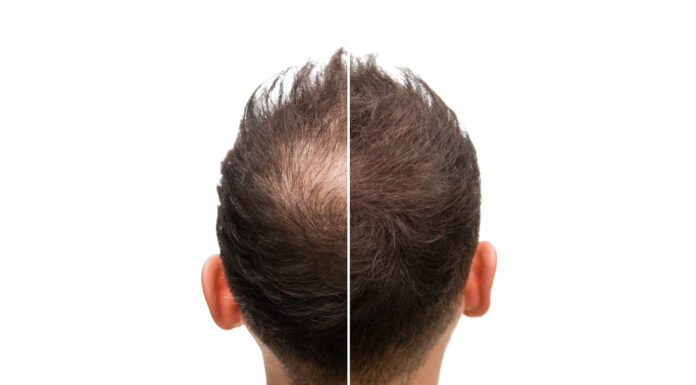 Symbolbild. Vorher Nachher - Halbglatze eines Mannes mit Haarausfall. Copyright: unigraphy - stock.adobe.com