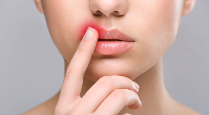 AiCuris überzeugt mit Pritelivir bei Herpes-simplex-Infektionen Symbolbild. "Woman touching lips". Copyright: Africa Studio - stock.adobe.com