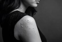 Symbolbild "hidradenitis suppurativa". Copyright: Premium Graphics - stock.adobe.com