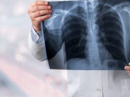 BioNTech punktet mit Lungenkrebsdaten – reicht das für einen Kursimpuls? Symbolbild "Lungenkrebs". Cancer. Copyright: BillionPhotos.com - stock.adobe.com