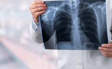 BioNTech punktet mit Lungenkrebsdaten – reicht das für einen Kursimpuls? Symbolbild "Lungenkrebs". Cancer. Copyright: BillionPhotos.com - stock.adobe.com