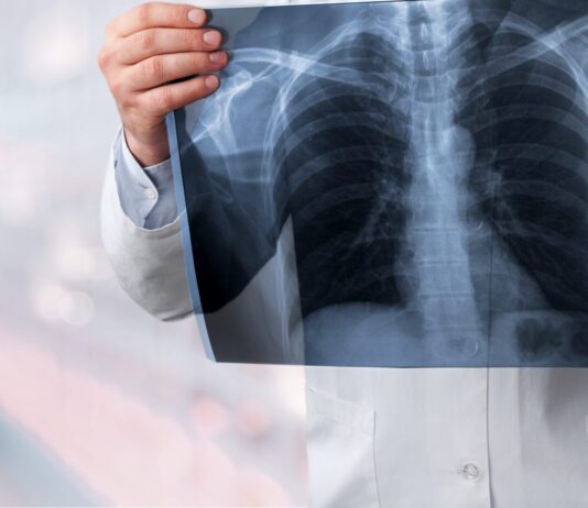 BioNTech punktet mit Lungenkrebsdaten – reicht das für einen Kursimpuls? Symbolbild "Lungenkrebs". Cancer. Copyright: BillionPhotos.com - stock.adobe.com