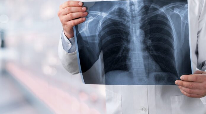 Symbolbild "Lungenkrebs". Cancer. Copyright: BillionPhotos.com - stock.adobe.com