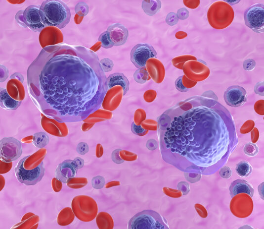Weihnachtsgeschenk für T-CURX: Series A mit 20 Mio. USD Ziel Symbolbild. Acute myeloid leukemia (AML) cells in blood flow - isometric view 3d, Copoyright LASZLO - stock.adobe.com
